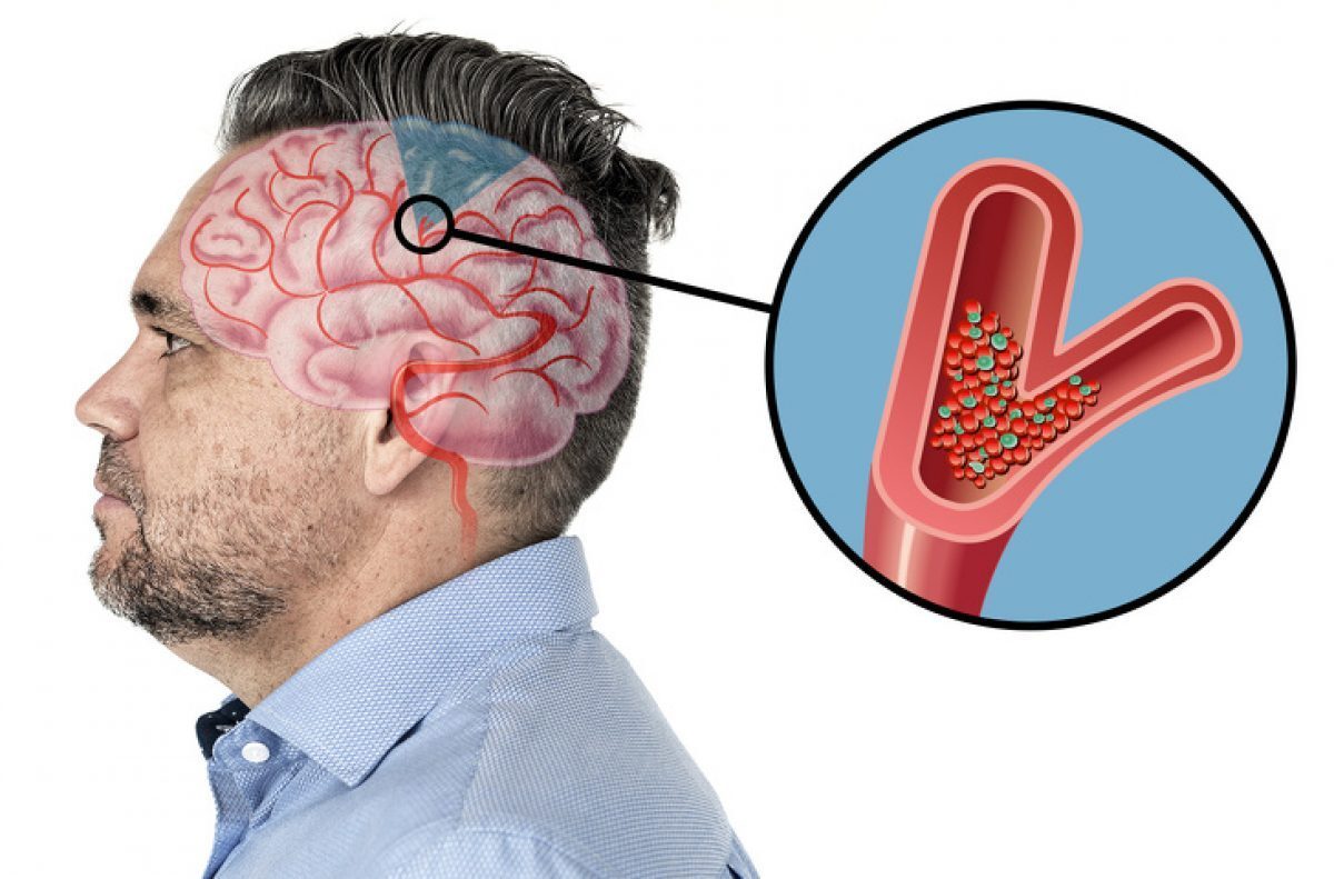 A Month Before Stroke, Your Body Will Warn You With These 10 Signals